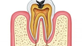 Tiết lộ bí quyết chữa đau răng hiệu quả tại nhà của ông chú Nha sĩ