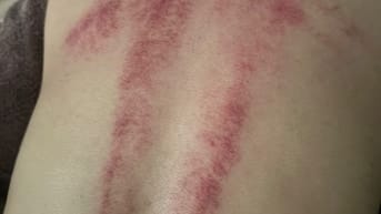 THỦY LAM massage điều trị phục hồi sức khỏe ĐÔNG Y NAM NỮ tại nhà 
