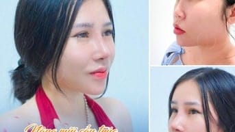 Nâng mũi cấu trúc sụn surgiform
