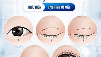 Giải pháp tạo nếp mí tự nhiên cho người bận rộn