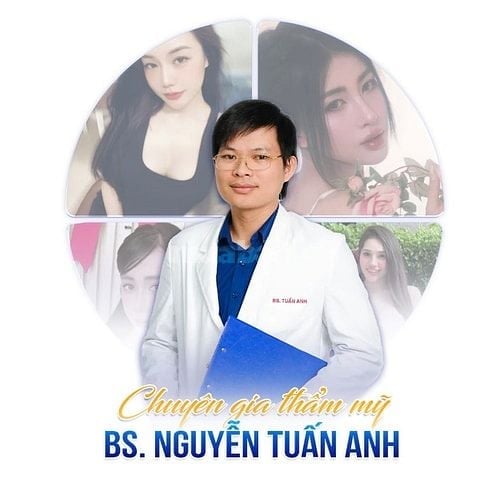 Nâng mũi cấu trúc sụn sinh học