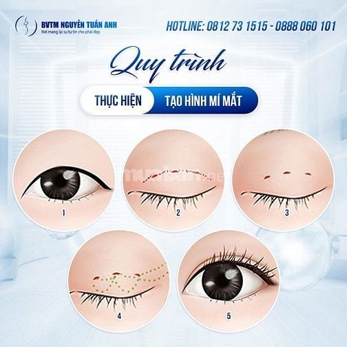 Giải pháp tạo nếp mí tự nhiên cho người bận rộn