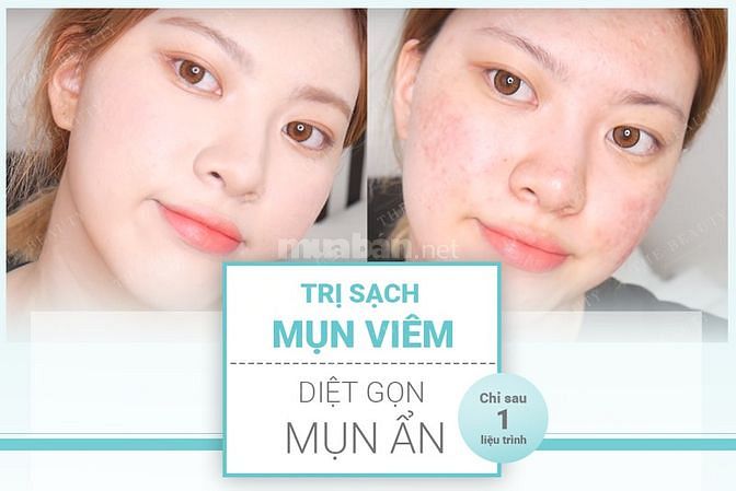 Dịch vụ chăm sóc da mụn tận nơi.tp hcm, bd, dn 62292812 Dịch vụ chăm sóc da mụn tận nơi.tp hcm, bd, dn