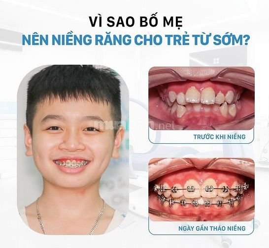 Độ tuổi niềng răng hợp lý nhất