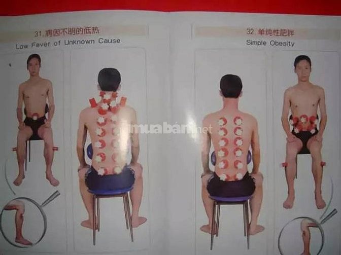 Cạo Gió Giác Hơi Tại Nhà Quận 8 - Bấm Huyệt Giác Hơi Quận 7 Chữa Bệnh