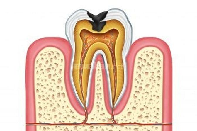 Tiết lộ bí quyết chữa đau răng hiệu quả tại nhà của ông chú Nha sĩ