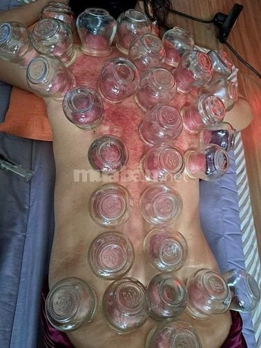 Cạo Gió - Giác Hơi - Cắt Lễ - Xoa Bóp - Xông Hơi (tại nhà)