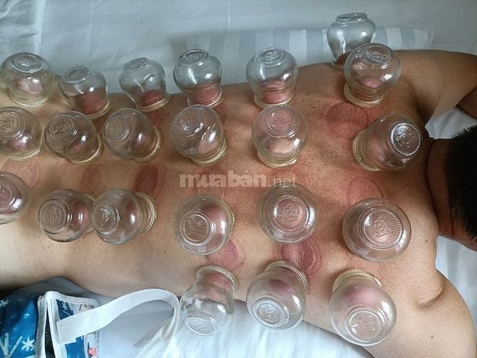 Nhận Cạo gió giác hơi đá nóng. Massage body foot 