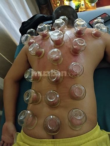 Cạo Gió - Giác Hơi - Xông Hơi ( Tận Nhà)