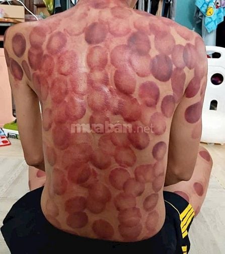 Cạo Gió -Giác Hơi - Xoa Bóp (Tận Nhà)