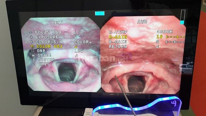 MÁY NỘI SOI TAI MŨI HỌNG KHÔNG DÂY FORU HÀN QUỐC 