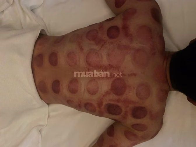 Massage trị liệu  Cạo Gió -Giác Hơi - Xoa Bóp (Tận Nhà)