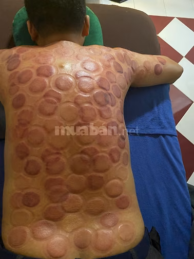 Cạo Gió - Giác Hơi - Chăm Sóc Sức Khoẻ (Tại Nhà)