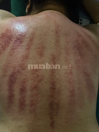 Cạo Gió - Giác Hơi - Chăm Sóc Sức Khoẻ (Tại Nhà)