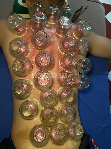 Cạo Gió - Giác Hơi - Chăm Sóc Sức Khoẻ (Tại Nhà)