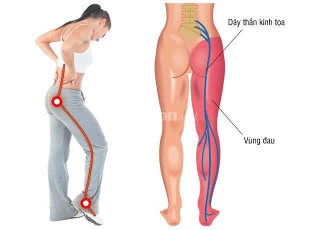 Dịch vụ trị liệu tận nơi cho người bịnh đau nhứt xương  khớp