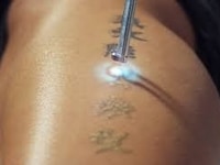 Xóa Xăm Công Nghệ Laser Toning Plus - Spa Hoa Sứ Xóa Xăm Công Nghệ Laser Toning Plus - Spa Hoa Sứ