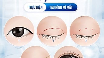Giải pháp tạo nếp mí tự nhiên cho người bận rộn