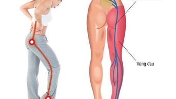 Dịch vụ trị liệu tận nơi cho người bịnh đau nhứt xương khớp